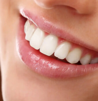 Tratamiento Clear Smile | Alineadores Transparentes