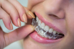 Descubre las razones para elegir alineadores invisibles en lugar de brackets tradicionales