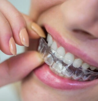 Descubre las razones para elegir alineadores invisibles en lugar de brackets tradicionales