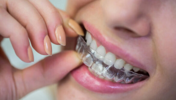 Descubre las razones para elegir alineadores invisibles en lugar de brackets tradicionales