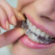 Descubre las razones para elegir alineadores invisibles en lugar de brackets tradicionales